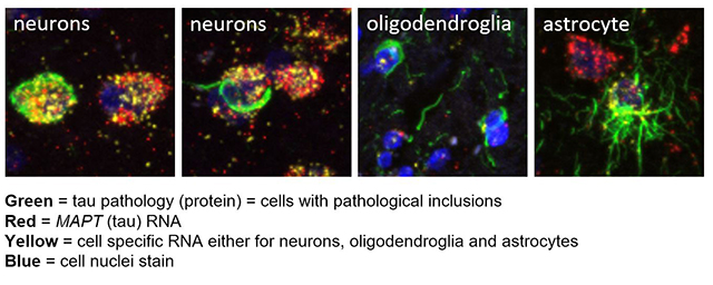 Shelley Forresr Acta Neuropathologica 2023