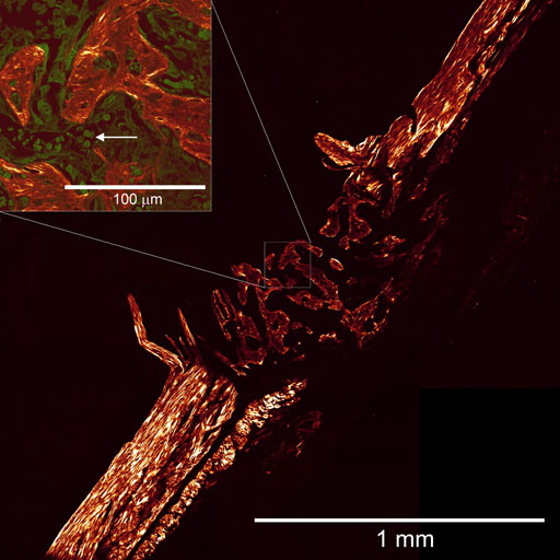 Figure. NLOM (SHG) image of the unstained mouse bone fracture, showing the bone regrowth (centre). Inset: An overlay image of SHG (red) and MPF (green) zoomed area (white square). Red blood cells (arrow) are clearly observable.  Preliminary results of our collaborative work with the ANZAC Research Institute investigators.