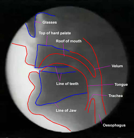 X-ray image of mouth and throat